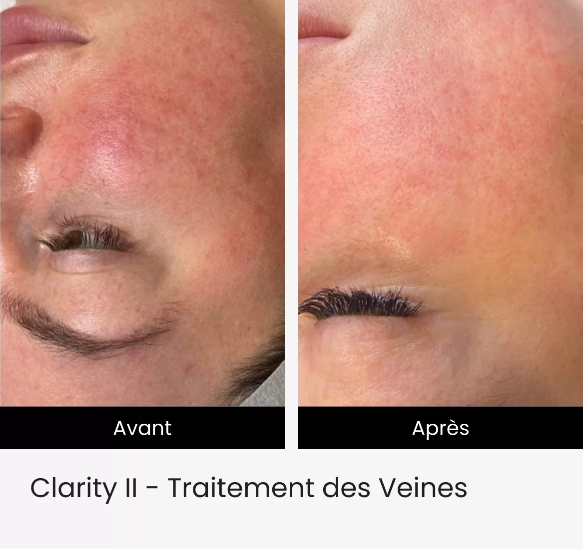 Clarity II - Traitement des Veines 1