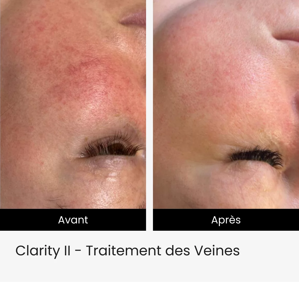 Clarity II - Traitement des Veines 2