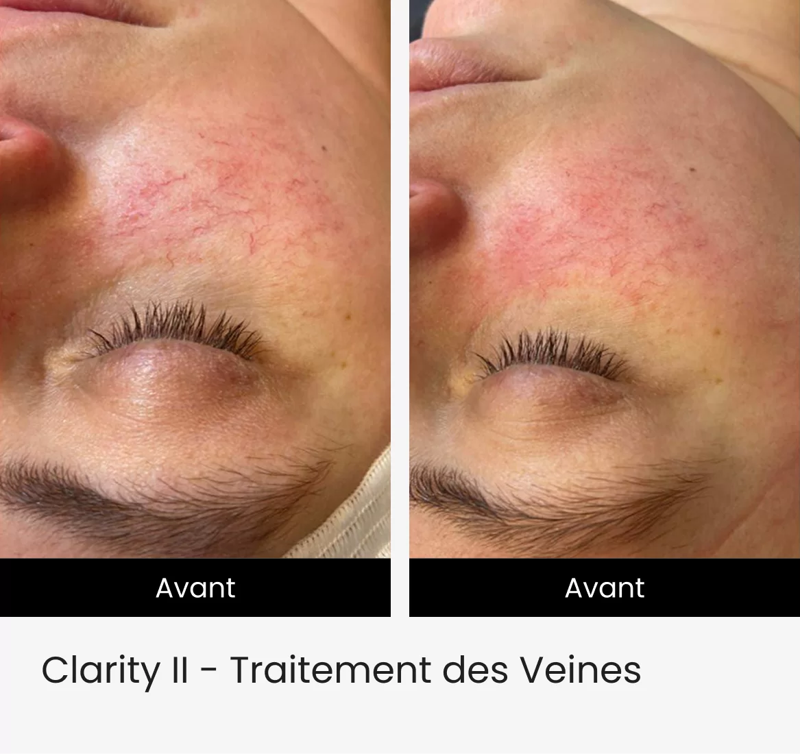 Clarity II - Traitement des Veines 3