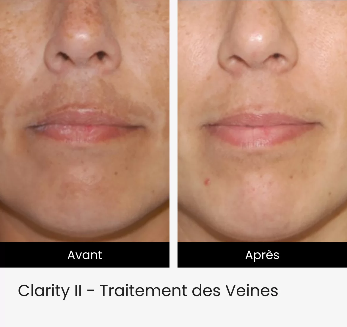 Clarity II - Traitement des Veines 4