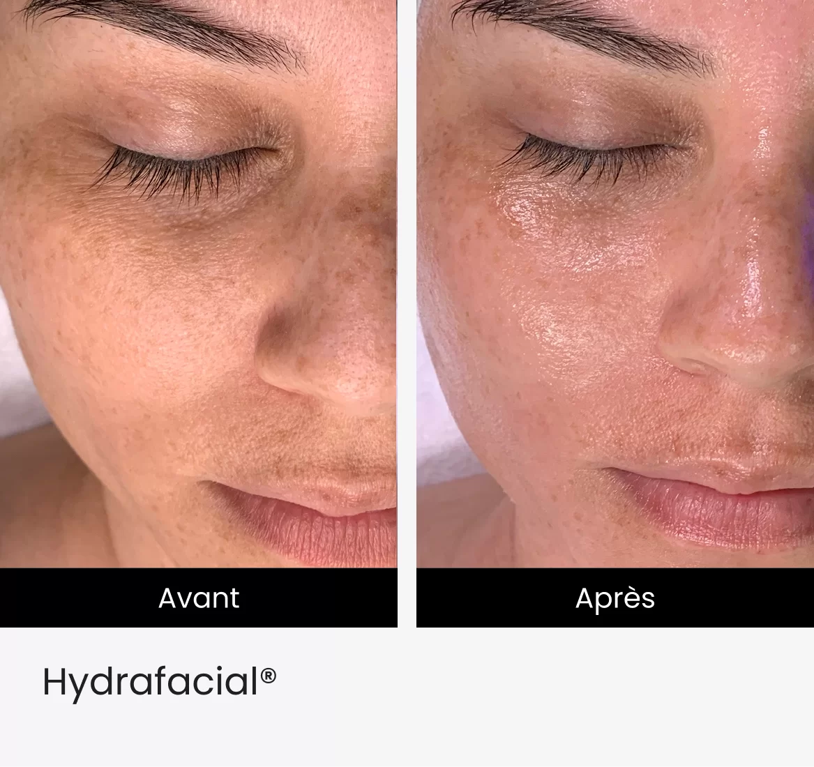 Hydrafacial® img 1