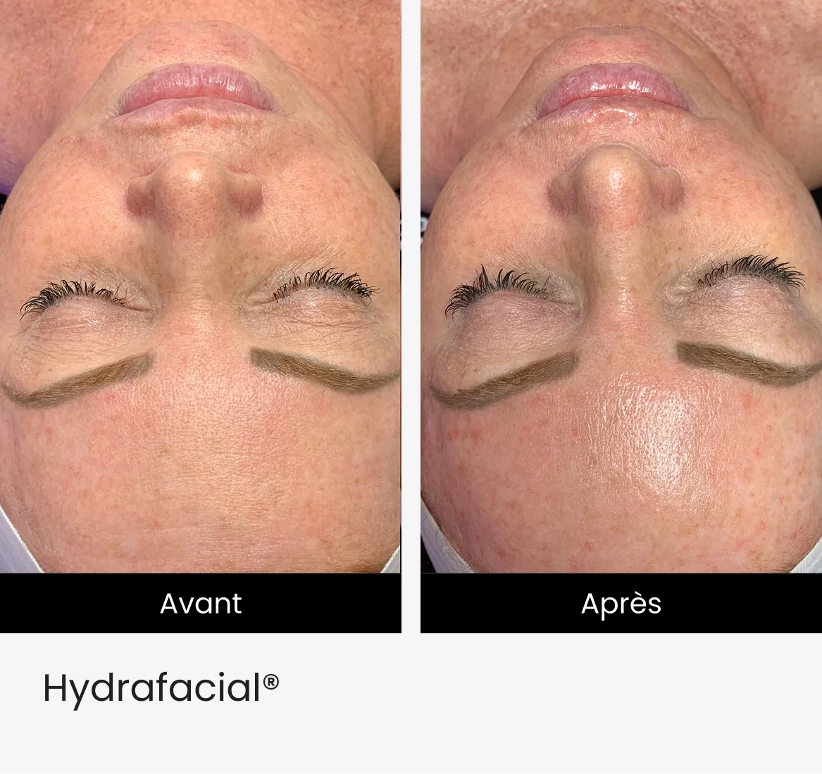 Hydrafacial® img 2