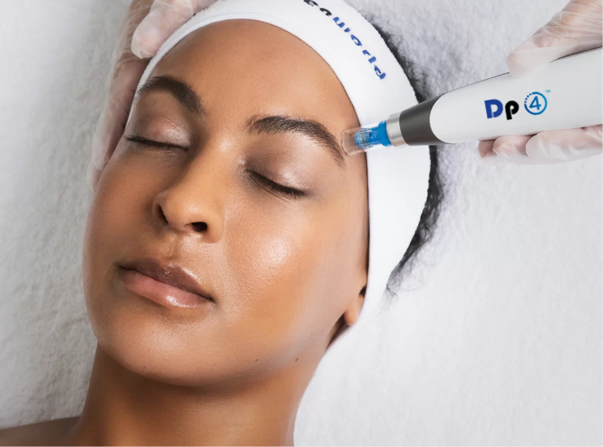 microneedling montreal