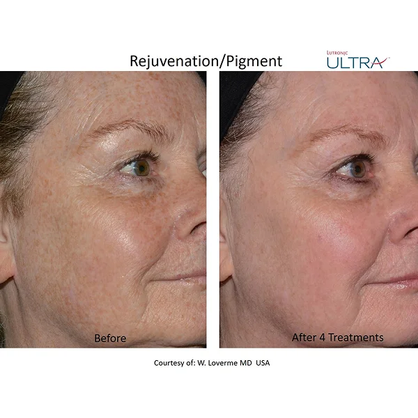 Avant et après le traitement de pigmentation pour une récupération rapide et un teint revitalisé.