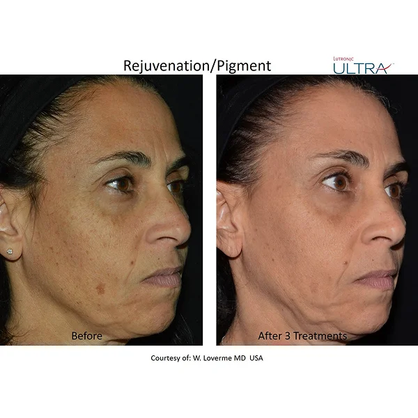 Femme montrant une photo avant et après de son visage, illustrant la transformation liée à la révolution beauté.